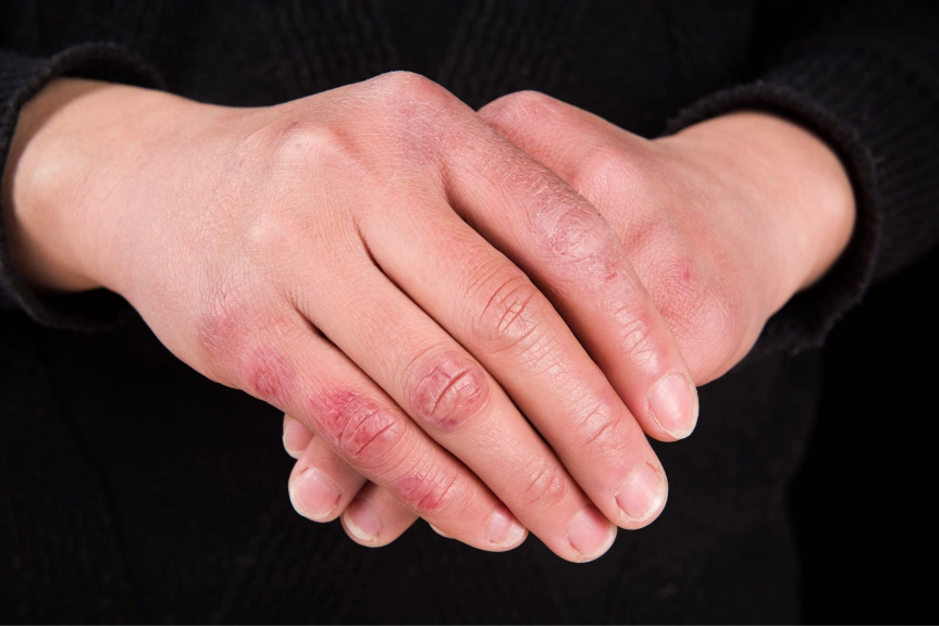 Chilblains
